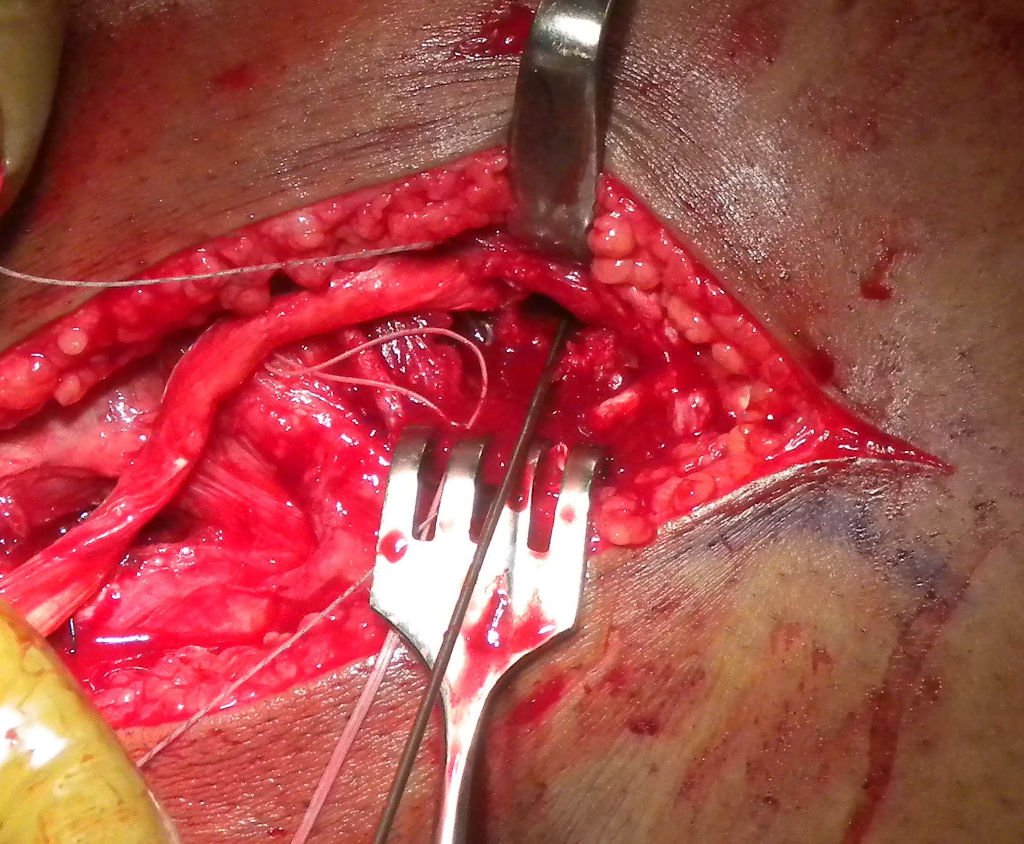 PLC Popliteus and LCL Femoral Drill Holes